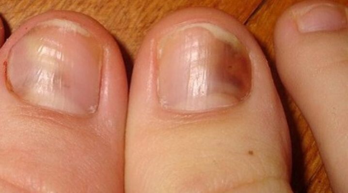 schimmel nagel infectie