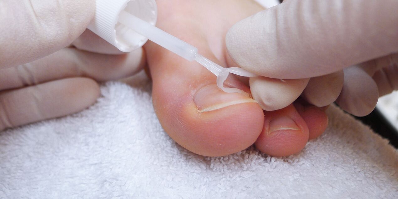 medicinale lak tegen nagelschimmel