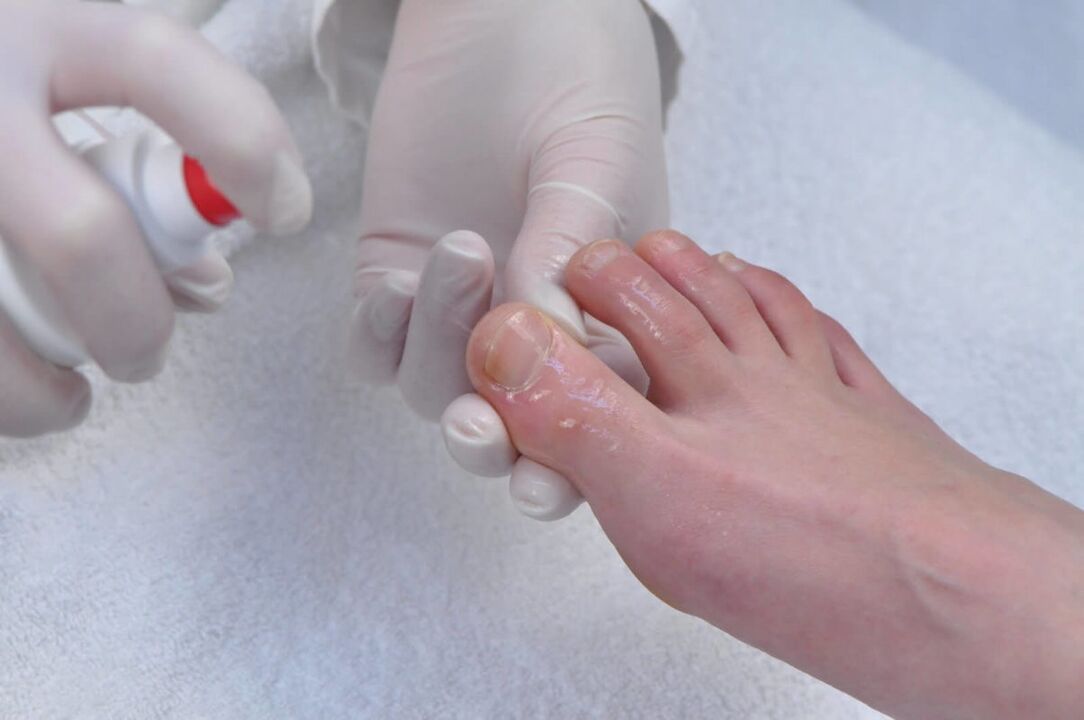 spray voor de behandeling van nagelschimmel