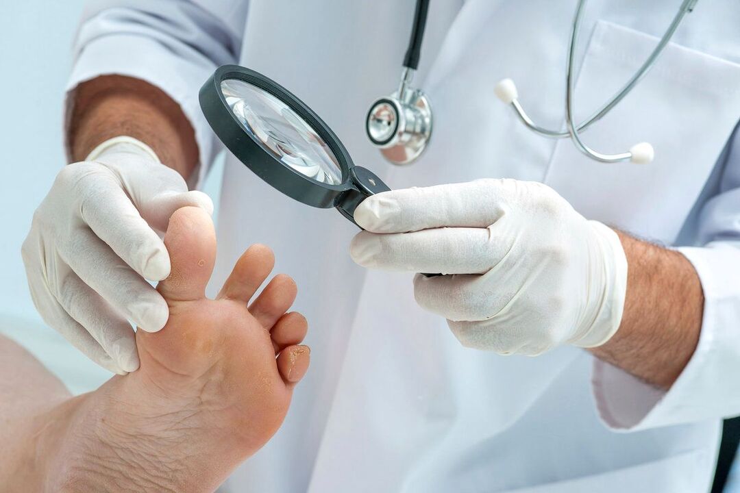 arts onderzoekt voeten met schimmel