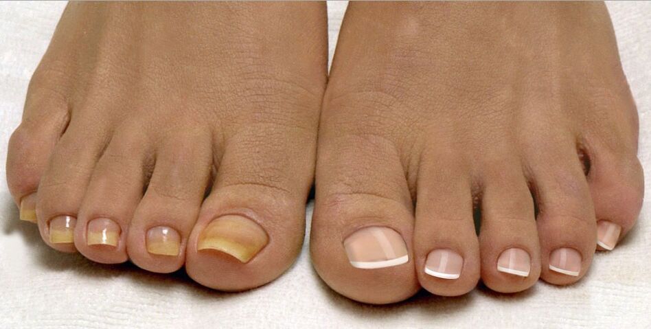 gezonde nagels en teennagelschimmel