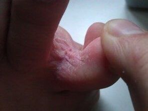 huidletsels tussen de tenen met een schimmel