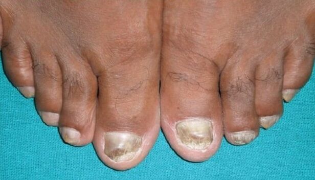 Schimmel op de nagels