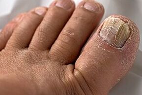 Foto van nagelschimmel