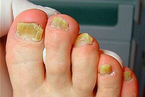 Nagelschimmel