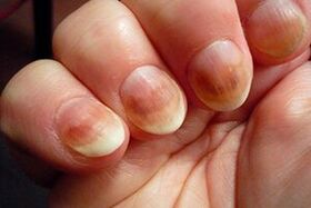 nagelschimmel