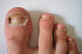 schimmel op de nagels