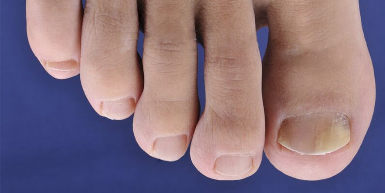 Symptomen van huid mycose en nagelplaten