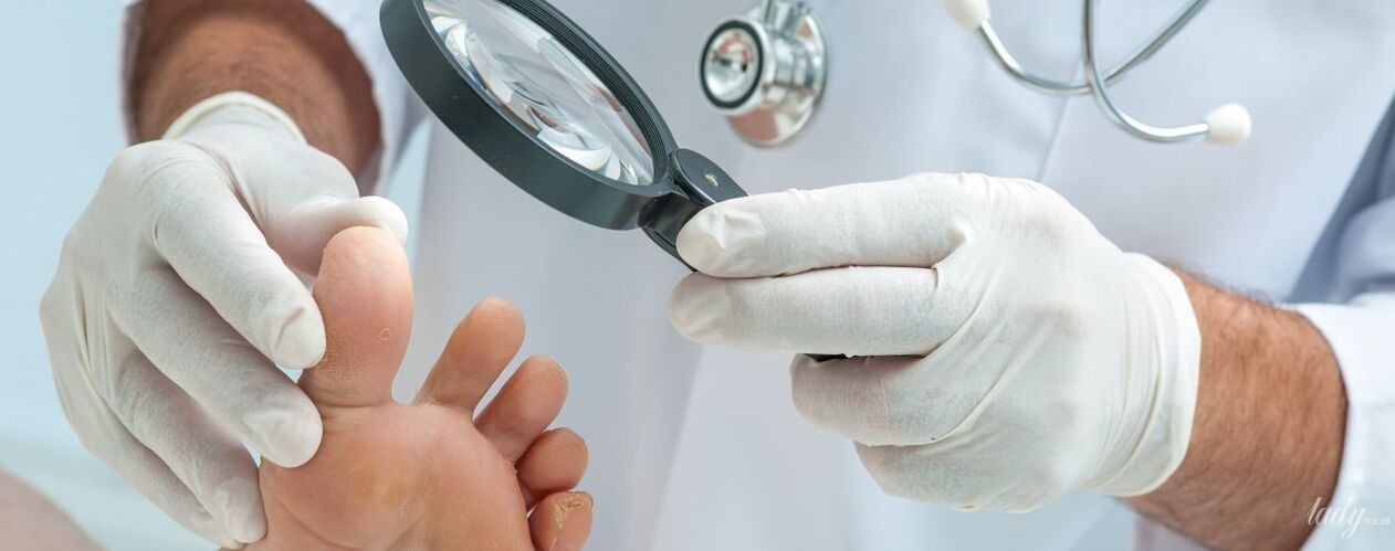 De dokter onderzoekt de schimmel op de teen