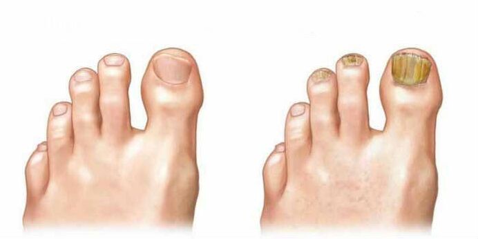 Hoe ziet de schimmel eruit op de nagels