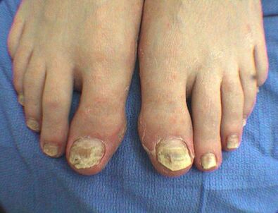 Symptomen van nagelschimmel