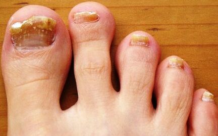 teennagels aangetast door schimmel