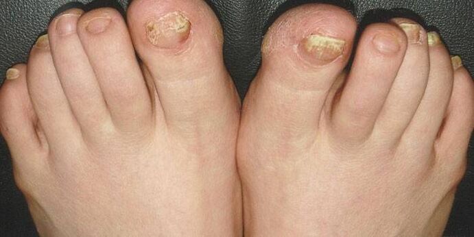wat is nagelschimmel