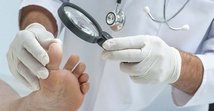 de dokter onderzoekt de voeten op nagelschimmel