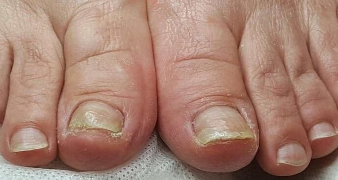 schade aan de nagels met schimmel op de voeten