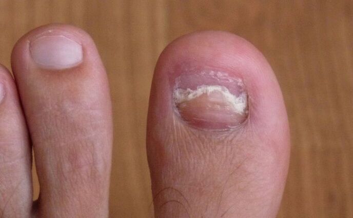 schade aan de nagel op de grote teen met een schimmel