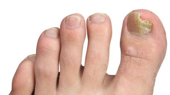 schade aan de nagelplaat met schimmel